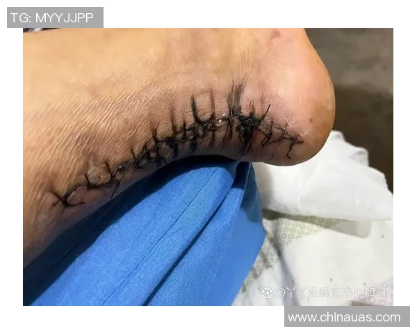 迪文岑佐因跟腱完全断裂今日在纽约接受手术恢复计划启动